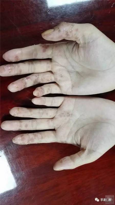 疑难病症系列陈根成治顽固性湿疹经验