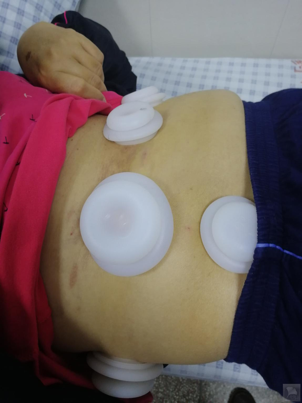 岐黄针治疗带状疱疹后遗神经痛病例分享和思考