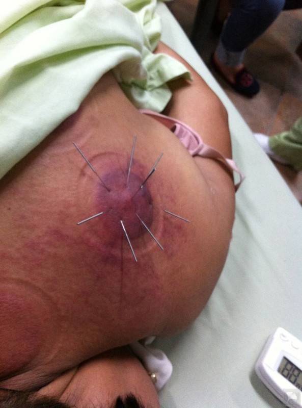 中医治疗肩胛骨缝周围纤维组织炎疼痛的方法 tcm treatment for fibro