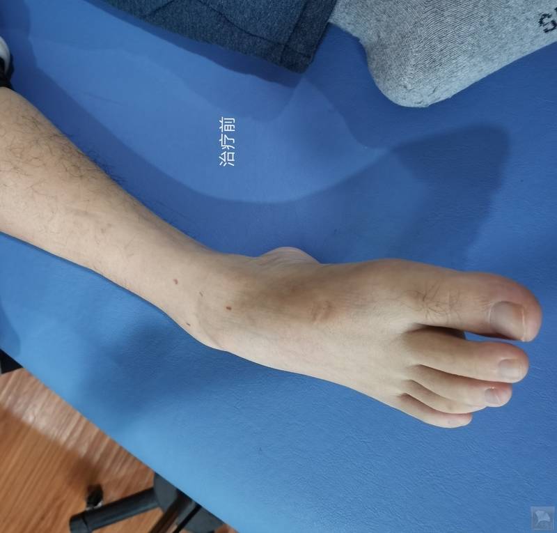 岐黄针治疗中风后足内翻病例分享