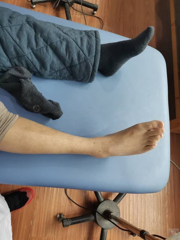 岐黄针治疗中风后足内翻病例分享