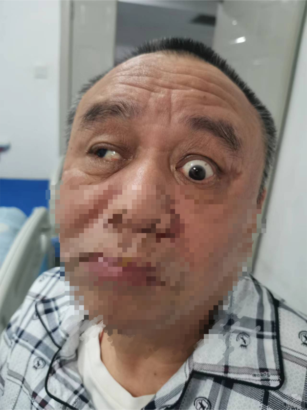 岐黄针疗法治疗脑梗死后动眼神经麻痹病例分享